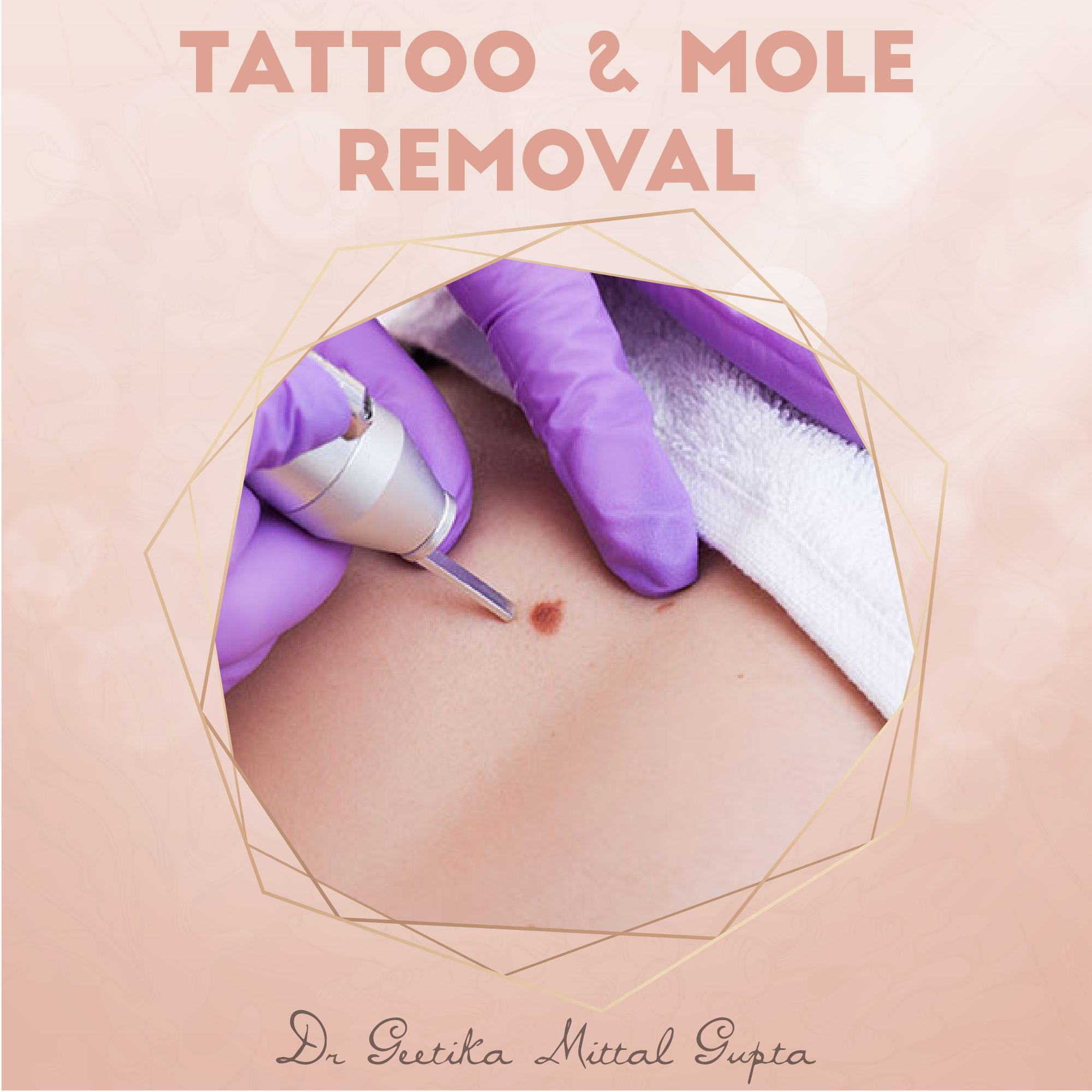 Are UV Tattoos worth the Risk? - Austin Tattoo Removal - Clean Slate Ink