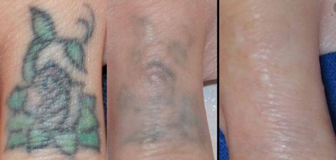 Tattoo Removal - Inkfree, MD Laser Clinic - Houston, TX